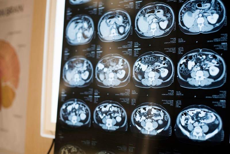 brain health